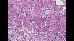 Esophagitis, also spelled oesophagitis, is a disease characterized by inflammation of the esophagus. Histopathology Esophagus Herpes Esophagitis Youtube