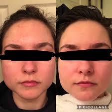 B A After Just Twelve Days Of Using Nizoral Masks And A Fa Safe Routine Skincareaddiction