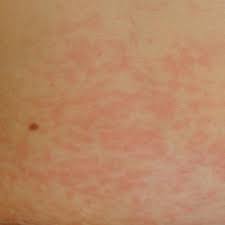 Delayed Cutaneous Reactions To Iodinated Contrast Mdedge Dermatology