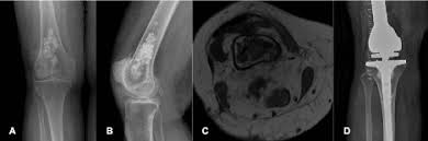Image result for Chondrosarcoma