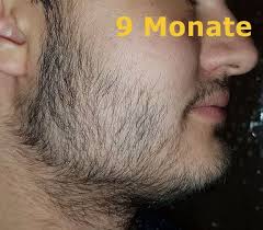 Erfahren sie jetzt wie der bartwuchs funktioniert. á…á… Minoxidil Bart Erfahrung Der Langzeit Test Monatliche Bilder