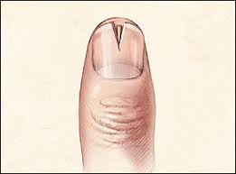 If you don't have any cocaine to numb the area around the splinter you can use solarcaine,oral b,etc. Splinter Removal American Family Physician