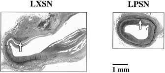 Prevention of Aneurysm Development and Rupture by Local Overexpression of  Plasminogen Activator Inhibitor-1