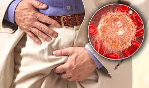 Testicular or penile cancers may also present as swollen lymph nodes in the groin, so top symptoms: Cancer Symptoms Tumour Signs Include Lumps Or Swollen Groin Express Co Uk