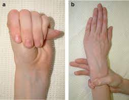 Marfan Syndrome: Clinical Diagnosis And Management | European Journal Of  Human Genetics