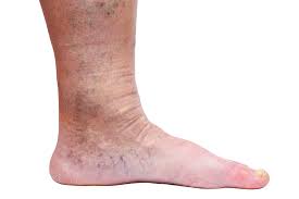 When Should You Consider Sclerotherapy Dermatology And Aesthetic Institute