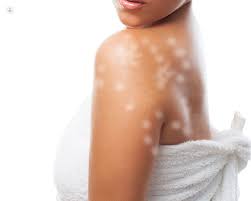 White Patches On The Skin