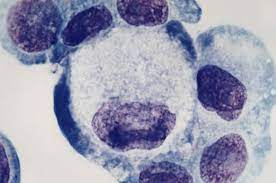 Exposure to certain factors in the environment, such as chemicals like asbestos and benzene, as well as talcum powder and various sources of radiation (including. Cancer Pesticide Action Network