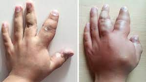Denn vor allem bei einer tiefen beinvenenthrombose. Compgefa Thrombophlebitis