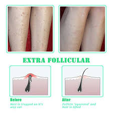 This will soften the skin and bring the ingrown hair to the surface, making it easier to pluck out. Amazon Com Tailaimei Exfoliating Brush For Ingrown Hair Treatment To Treat And Prevent Bikini Bumps Razor Bumps Silky Smooth Skin Solution For Men And Women Beauty