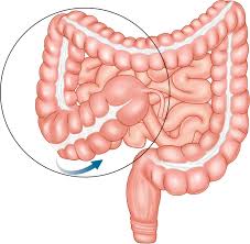 Mobile Cecum Syndrome | Ppt