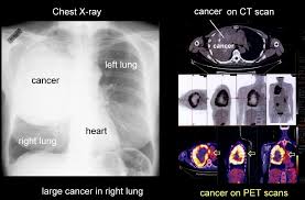 Image result for lung cancer xray