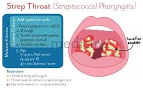 Emergency Streptococcal Pharyngitis Pediatric Nurse Practitioner Pharyngitis