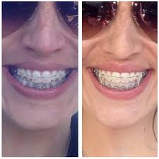 We did not find results for: Six Months In Braces Kaplan Orthodontics