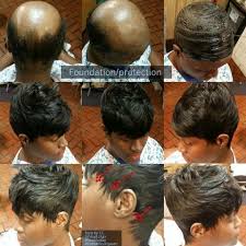 Transgender problems | side effects of male pattern baldness! Quickweave Protective Style Due To Alopecia Hair Styles Alopecia Hairstyles Hairstyles For Thin Hair