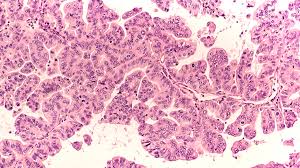 Ovarian cancer is a type of cancer that forms in ovarian tissues. Ovarian Cancer Cells Adapt To Their Surroundings To Aid Tumor Growth Science Research News Frontiers