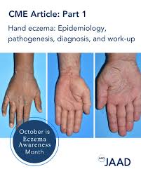 Image result for Hand Dermatitis