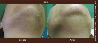 So yes, you may notice a bit more hair falling out when you first begin laser hair therapy. Laser Hair Removal Specialist Scotch Plains Nj Darren S Chin Md Aesthetic Specialist Ohana Medical Spa
