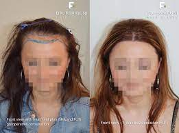 Pakete 100 % transparenz nur zufriedene kunden! Haartransplantation Frauen So Funktioniert S Hairforlife