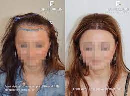 Kosten und nutzen der mittel gegen haarausfall und der haarverpflanzung vergleichen. Haartransplantation Frauen So Funktioniert S Hairforlife