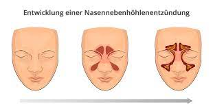 Weitere schwere erkrankungen vorhanden sind Nasennebenhohlenentzundung Behandlung Volksversand Versandapotheke