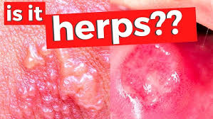Image result for genital herpes
