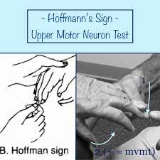 A positive homan's sign in the presence of other clinical signs may be a quick indicator of dvt. Lil Bone Peep On Twitter Hoffmann S Sign Upper Motor Neuron Test Perform By Flicking Or Tapping The Nail While Relaxed Sign If The Thumb Index Finger Reflexively Adduct Flex