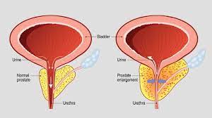 One in seven men in the united states will receive a prostate cancer diagnosis during his lifetime. 7 Reasons Your Psa Level May Be High Besides Cancer Everyday Health