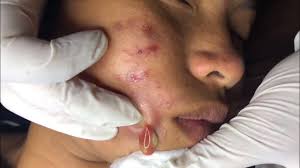 (however, if you are removing your own blackhead—because let's be real, we all get them—this is how to do it correctly.) in addition to the video that made 22 million this man's poor wife didn't have any luck removing these blackheads from his back, so they turned to a professional for help. Blackhead Extraction Videos 2020