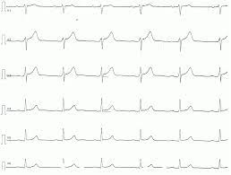 The pathology of the heart, ed. Pericarditis Myocarditis Perimyocarditis Ecg Criteria Treatment Ecg Echo
