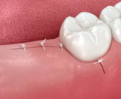 Image result for Tooth Extraction