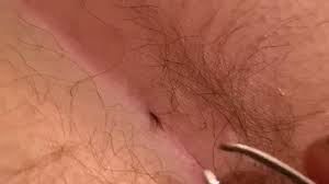 They typically affect people with thick, curly hair, and can become infected if left untreated. Montage Video Kizoa Laser Surgery For Pilonidal Sinus Laser Pilonidoplasty By Dr Mohamed Abid
