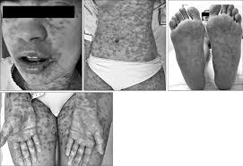 Stevens Johnson Syndrome And Toxic Epidermal Necrolysis A Review