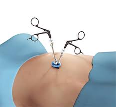 This reduces the amount of food a person can eat in one sitting, thereby ensuring they feel full after consuming just a small portion of food. Single Incision Laparoscopic Surgery New York Colon Repair Long Island Hewlett Ny