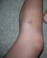 What does a spider bite look like? Spider Bite
