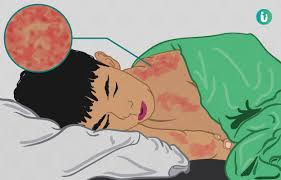 खसर क लक षण क रण इल ज दव उपच र और परह ज Khasra Measles Ke Lakshan Karan Ilaj Dawa Upchar In Hindi