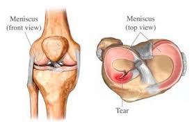 A pulled hamstring is a sports injury that causes pain and muscle spasm in the back of the thigh. Hamstring Injury Archives Love Yoga Anatomy