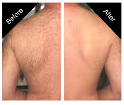 Get rid of unwanted back & chest hair the easy way with this guide to effective hair removal. Permanent Back Hair Removal Cheaper Than Retail Price Buy Clothing Accessories And Lifestyle Products For Women Men