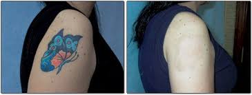 Yes, we do partial tattoo removals. Non Laser Tattoo Removal San Antonio Texas Mad Makeup Microblading Tattoo Removal