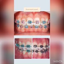 Great Smile Dental Melaka Braces Orthodontic 06 2331555 018 2419392 Facebook