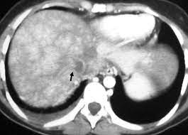 Diagnostic And Interventional Radiology For Budd Chiari Syndrome Radiographics