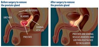 Treating Localized Prostate Cancer Comparative Effectiveness Review Summary Guides For Consumers Ncbi Bookshelf
