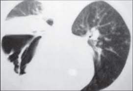 La mucormicosis es una infección por hongos saprofitos de la cavidad nasal y senos paranasales de los géneros mucor, absidia y rhizopus. Tac De Torax Dia 15 Imagen De Absceso Pulmonar Izquierdo De 10 Cm De Download Scientific Diagram