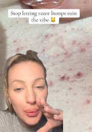 Warm Compress for Ingrown Hair