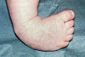 Image result for Clubfoot