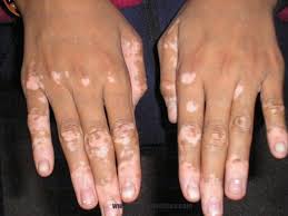 Nadie sabe qué causa el vitíligo, pero puede ser una enfermedad autoinmunitaria. Vitiligo Afecta Mas A Hombres Y Mujeres De Entre 18 Y 30 Anos Colima Noticias