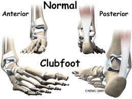 As development progressed, the foot could not grow normally because it was turned under and held in that position. Physical Therapy In Plymouth For Pediatric Issues Clubfoot