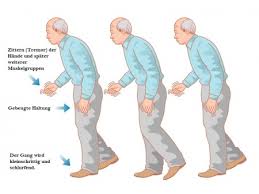 Parkinson disease (pd), also known as idiopathic parkinsonism, is a neurodegenerative disease and movement disorder characterized by resting tremor, rigidity and hypokinesia due to progressive. Parkinson Ursachen Beschwerden Therapie Gesundpedia De
