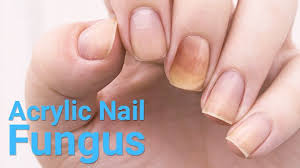 Nail polish remover and other nail treatments may contain chemicals that can make nails easy to break. How To Get Rid Of Acrylic Nail Fungus Love Your Nails Hc Beauty