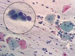Cytology Zoom On Twitter High Grade Squamous Intraepithelial Lesion Hisl Note The Coarse Chromatin And Inconspicuous Nucleoli As Well As The Thickened Irregular Nuclear Outlines Nuclear To Cytoplasmic N C Are Almost 1 1 Cytology Zytologie